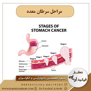 مراحل سرطان معده